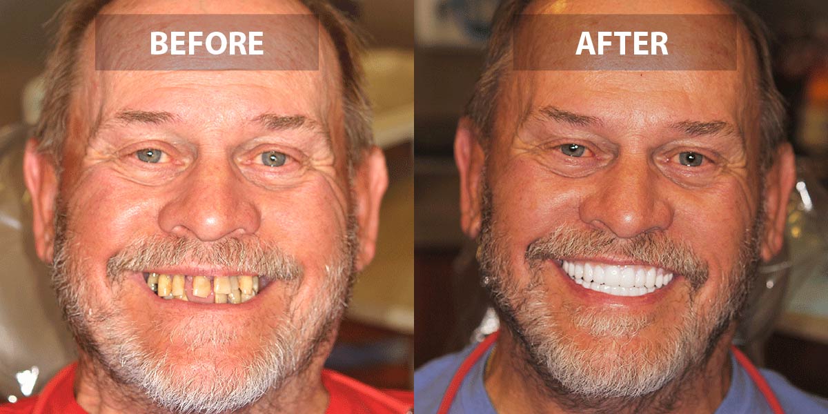 Before and After
